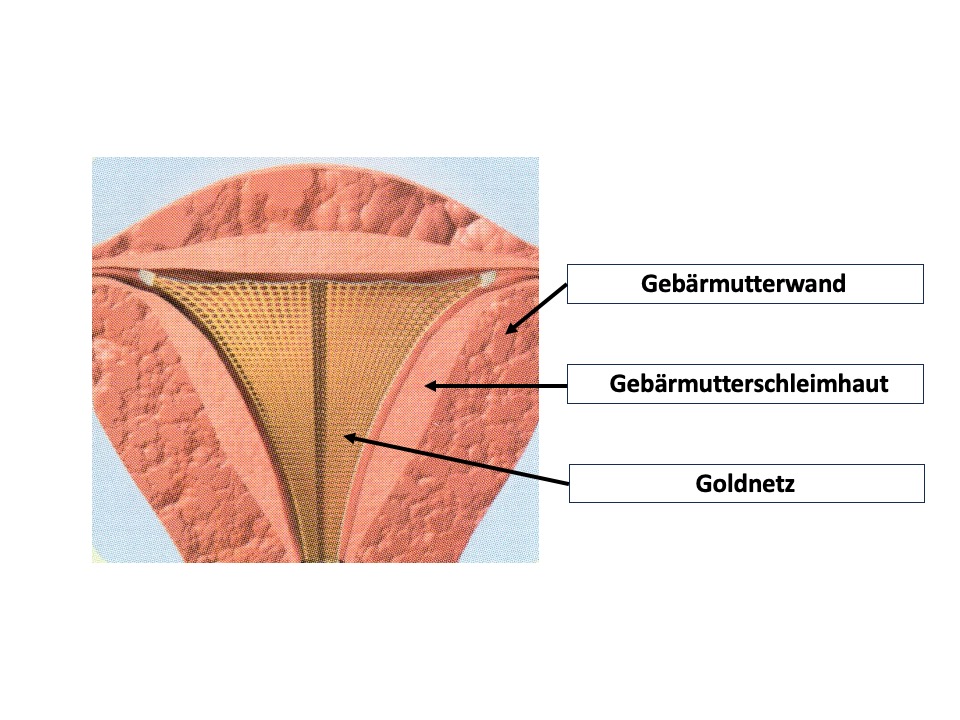 Ver dung Der Geb rmutterschleimhaut NovaSure Ver dung Der Geb rmutterschleimhaut NovaSure