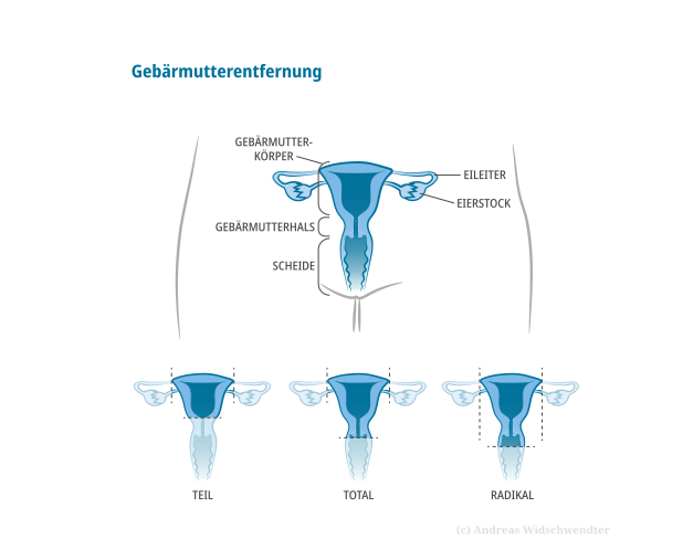 Gebärmutterentfernung
