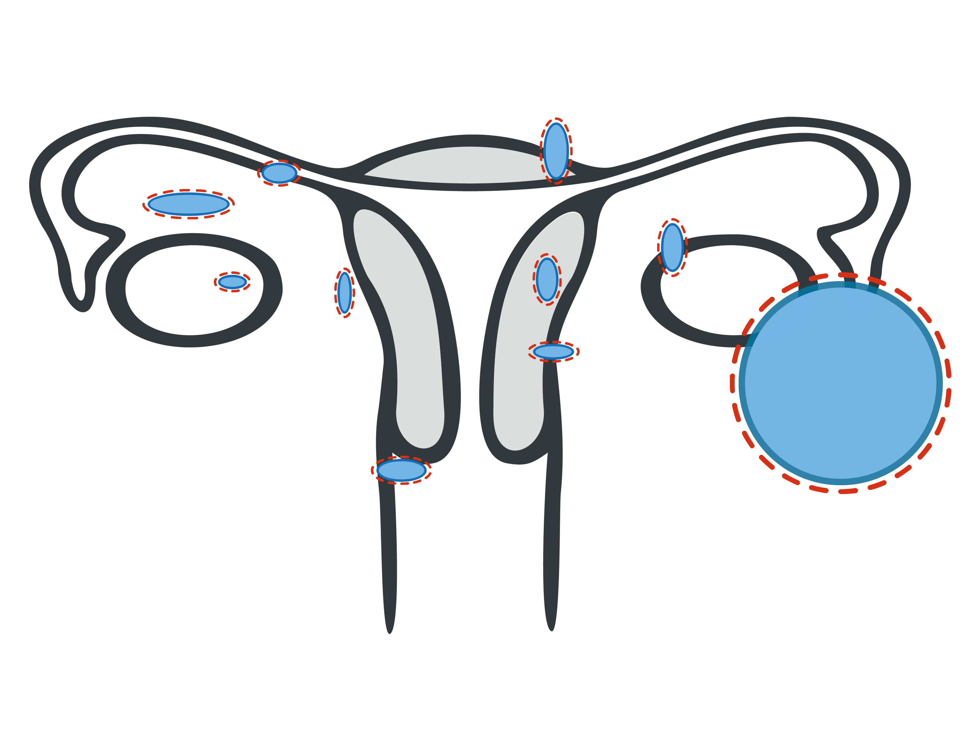 Grafik Endometriose OP