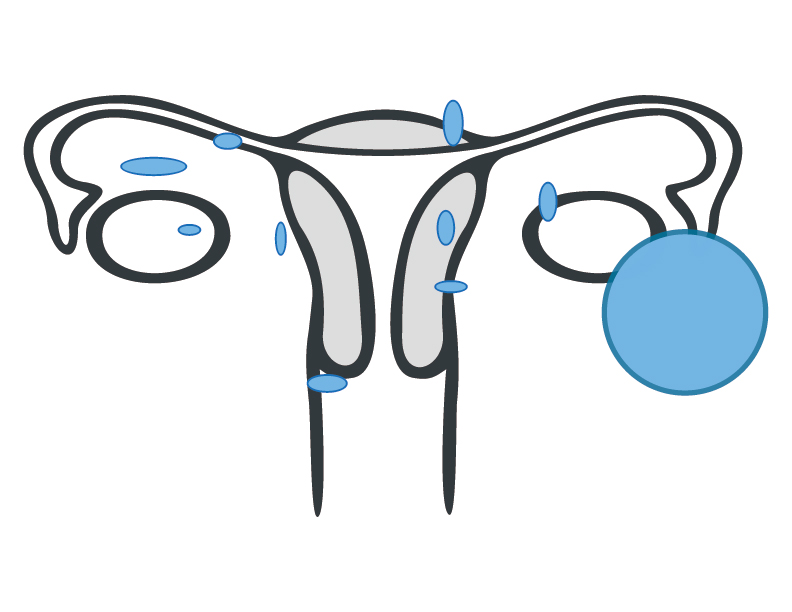 Grafik Endometriose
